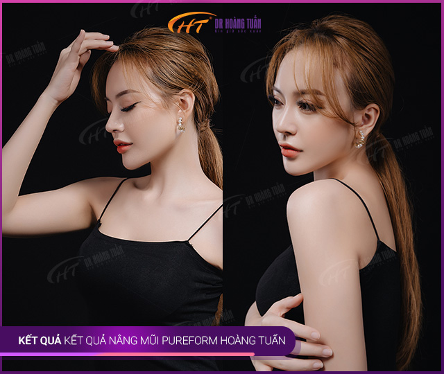 Kết quả nâng mũi Pureform tại Thẩm mỹ Hoàng Tuấn